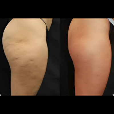 Ceinture-de-sudation-SweatCore-Sudation