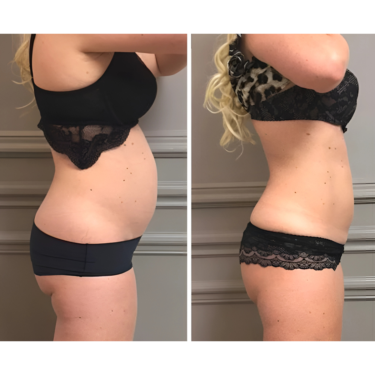 Ceinture-de-sudation-SweatCore-avant-apres